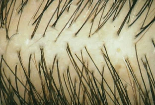 Représentation visuelle de la densité capillaire avant l'utilisation du shampoing Folicerin